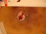 褥瘡　Pressure gangrene prevention
